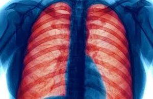 COPD 가정 요법
