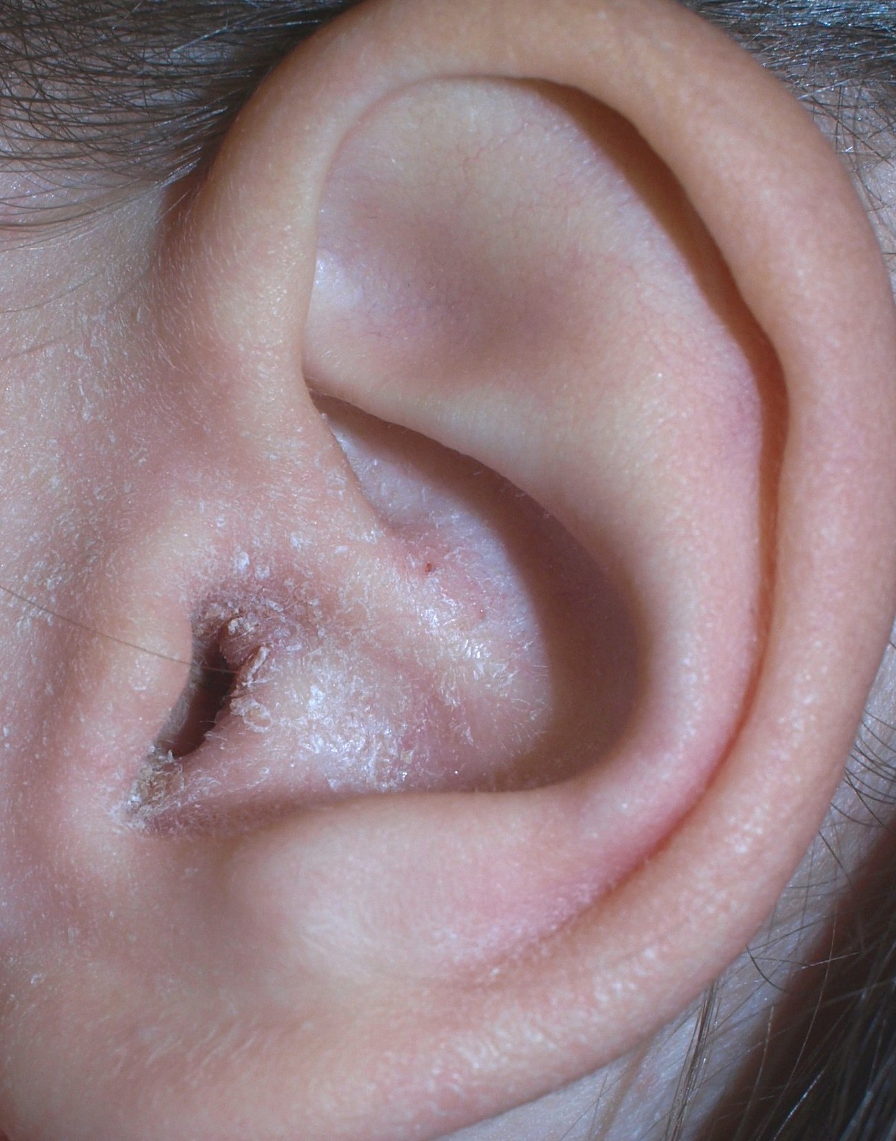 Hjemmehjælpemidler mod øreinfektioner