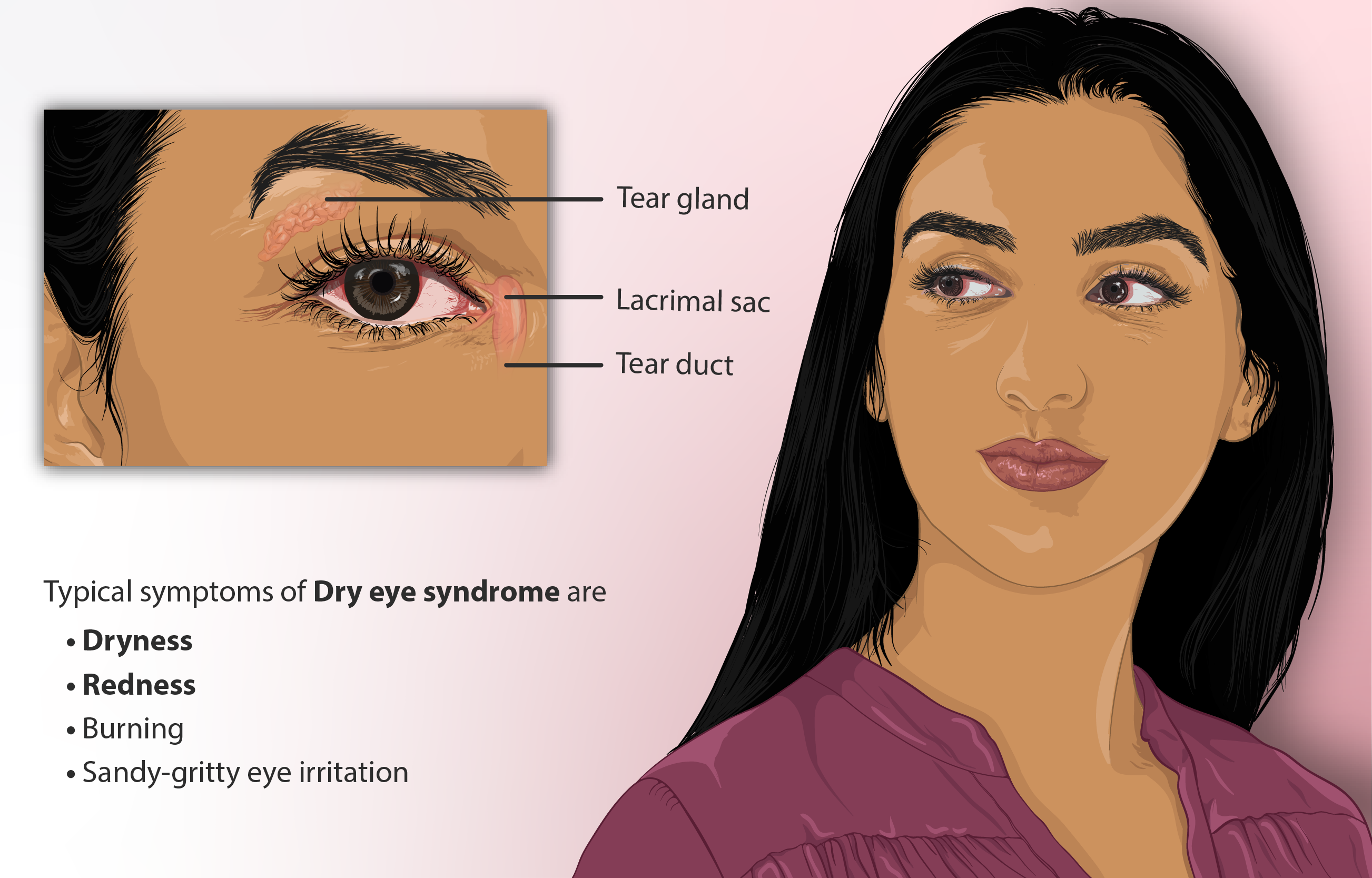 Datei:Darstellung einer Person, die am Syndrom des trockenen Auges leidet.png