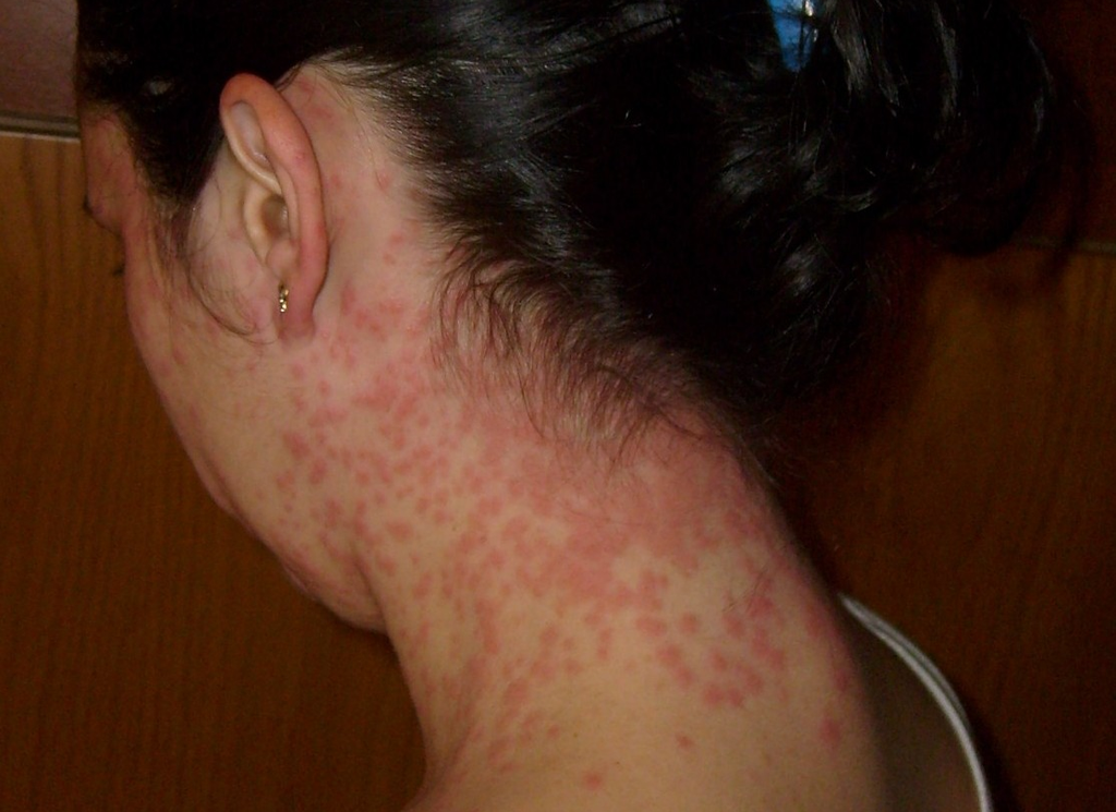 File:Euproctis Chrysorrhoea skin rash cutted.png - Wikimedia Commons