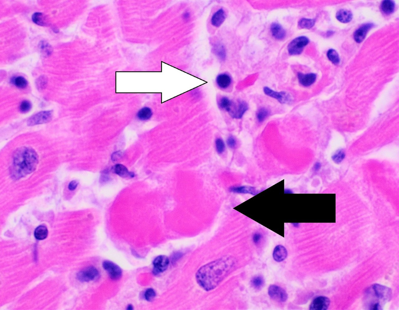 File:Histopathologie de la myocardite lymphocytaire avec myocyte