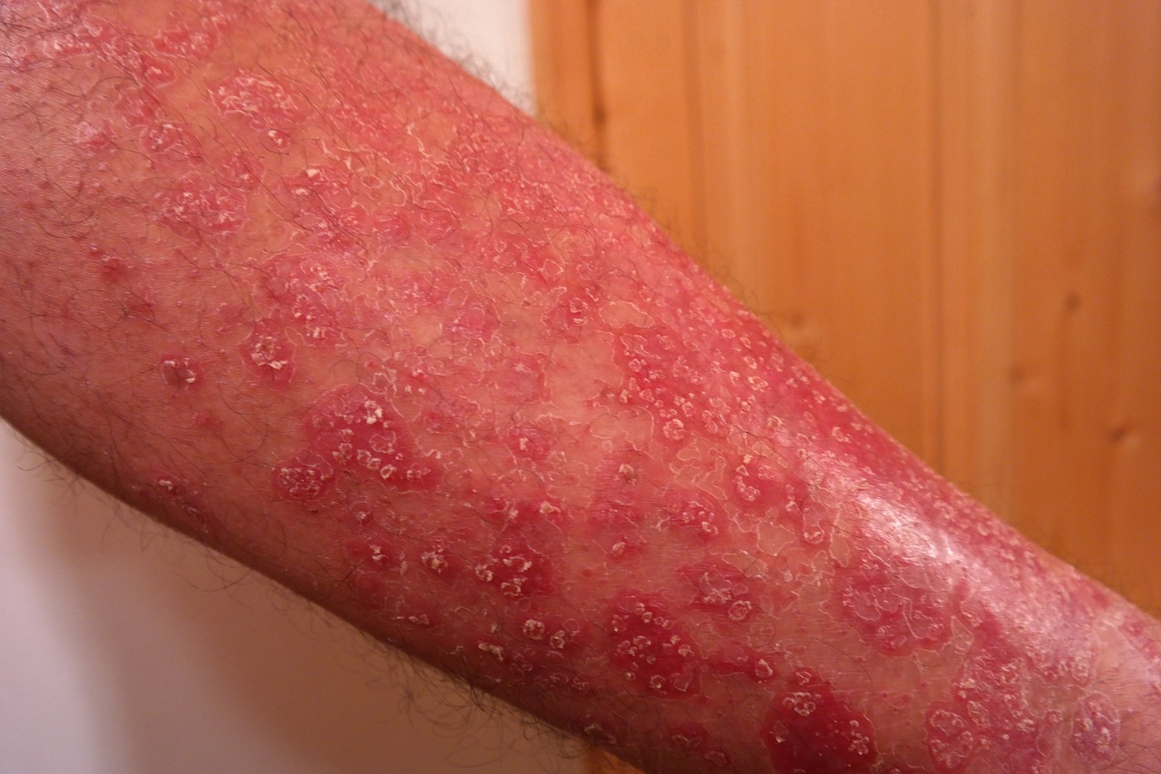 Psoriasis,maladie de la peau,rouge,squameuse,peau - image libre de needpix.com