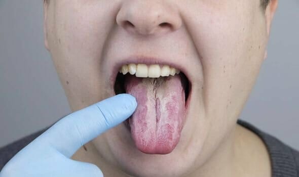 behandeling van een droge mond