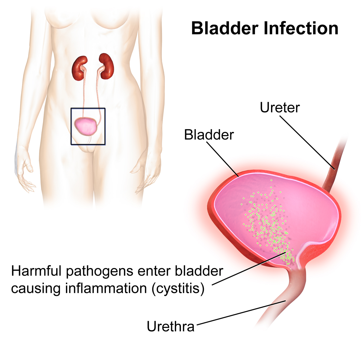 Tratamentul inflamației vezicii urinare