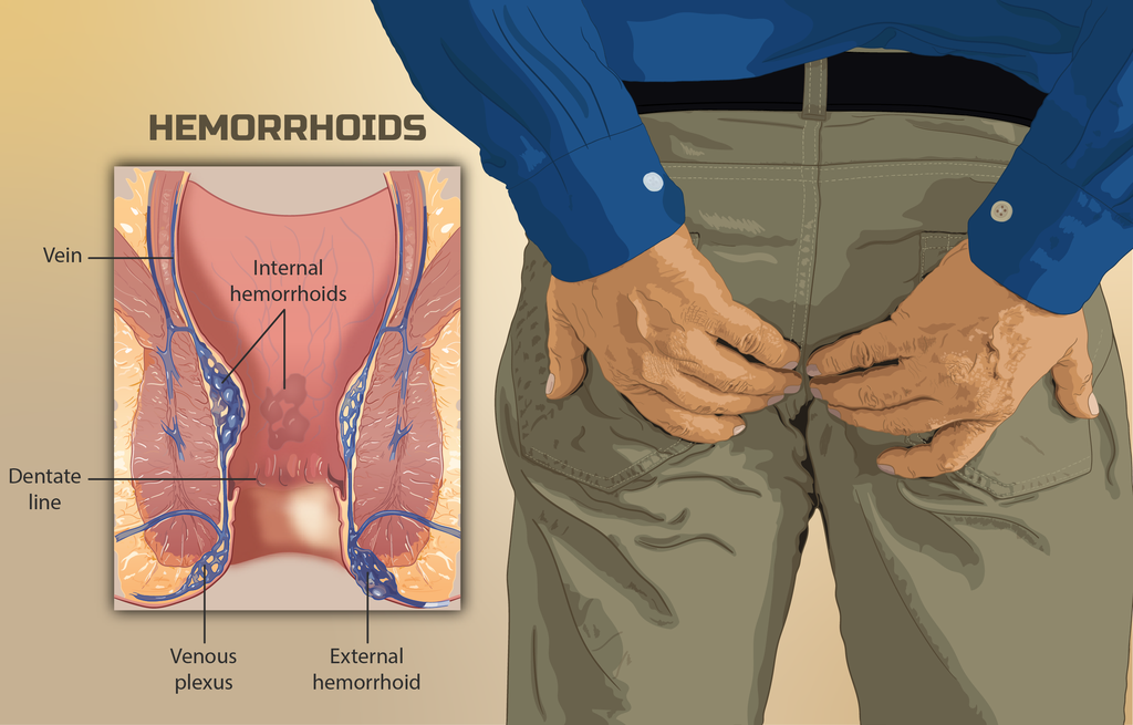 Evde Hemoroid Tedavileri