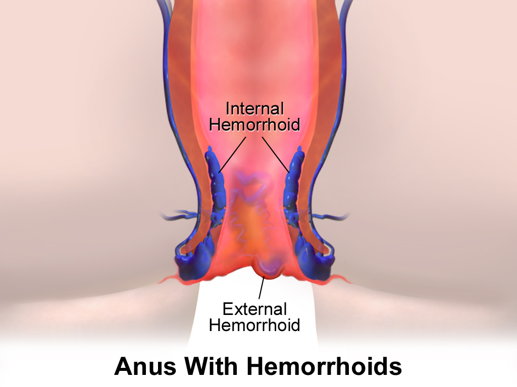 Hemorrhoids Treatment
