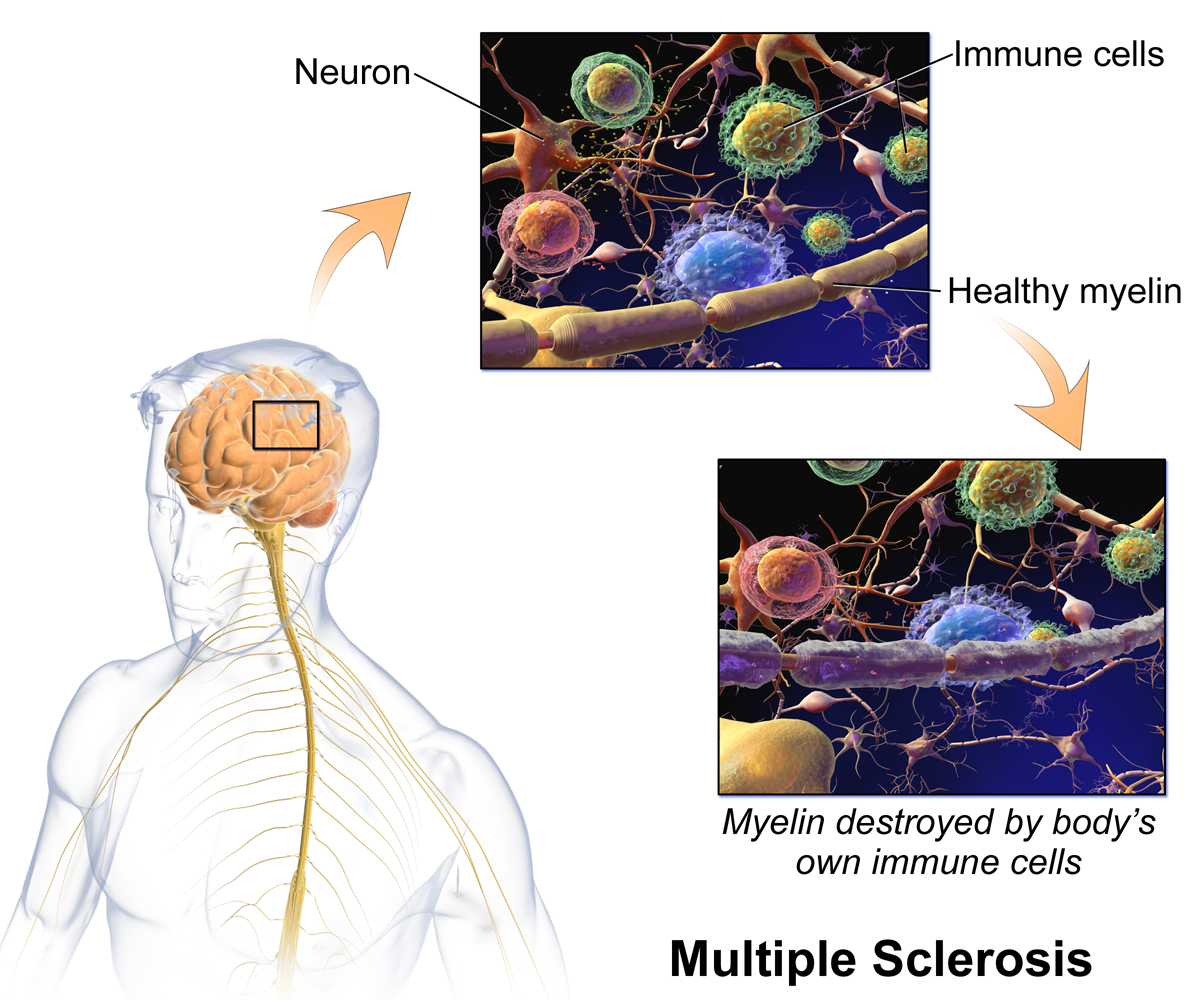 Tratamiento de la esclerosis múltiple