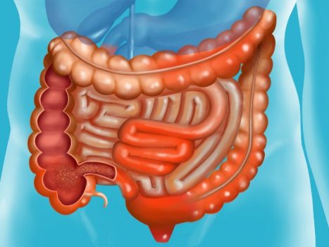 Crohn's Krankheit Haupt Remedies