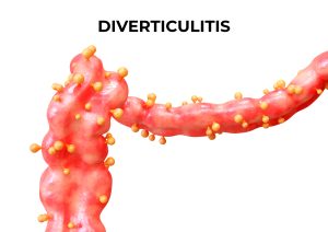 Diverticulitis hjem retsmidler