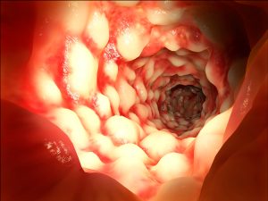 Intestine affected by the Morbus Crohn disease