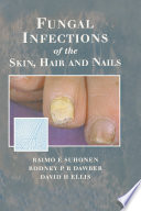 Schimmelinfecties van de huid en nagels